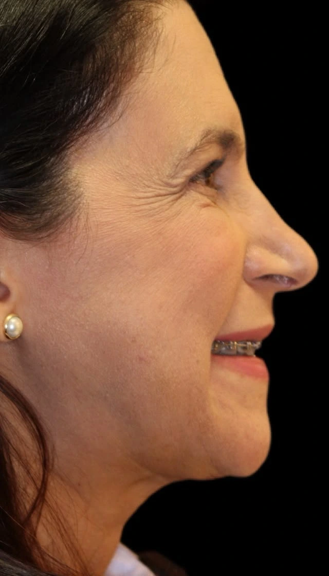Caso clínico 01 depois, em vista de perfil